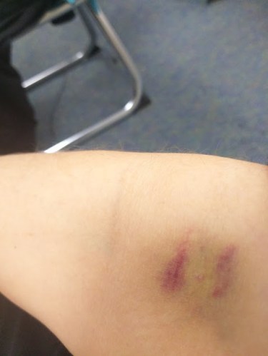 bruise